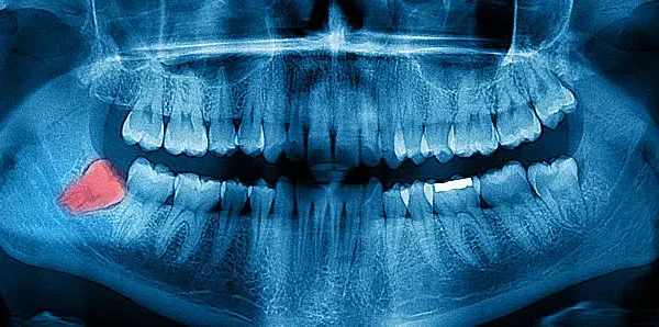 A Redução dos Dentes do Siso: Um Sinal da Evolução Humana Contínua